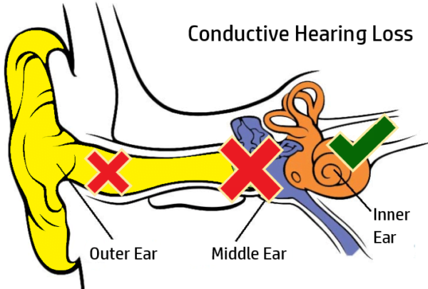 why-can-t-i-hear-types-and-causes-of-hearing-loss-you-need-to-know