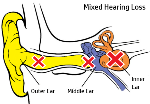 Why Can t I Hear Types And Causes Of Hearing Loss You Need To Know