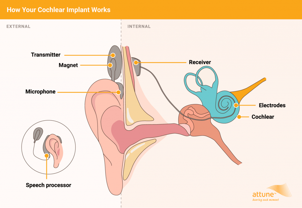 What Different Types Of Cochlear Implants Are There?