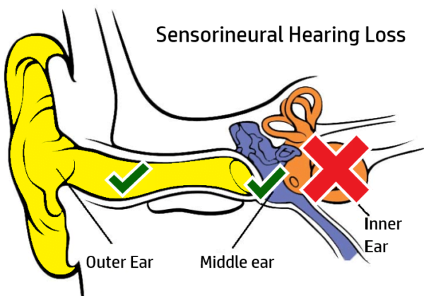 what-are-the-causes-of-sensorineural-hearing-loss-attune