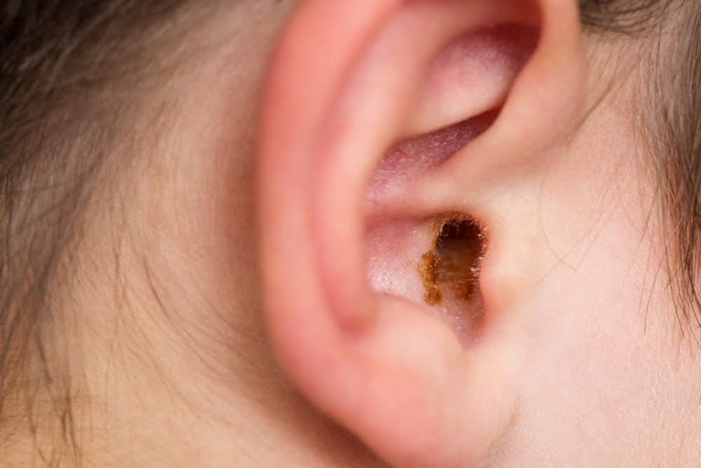 Will Impacted Earwax Fix Itself 